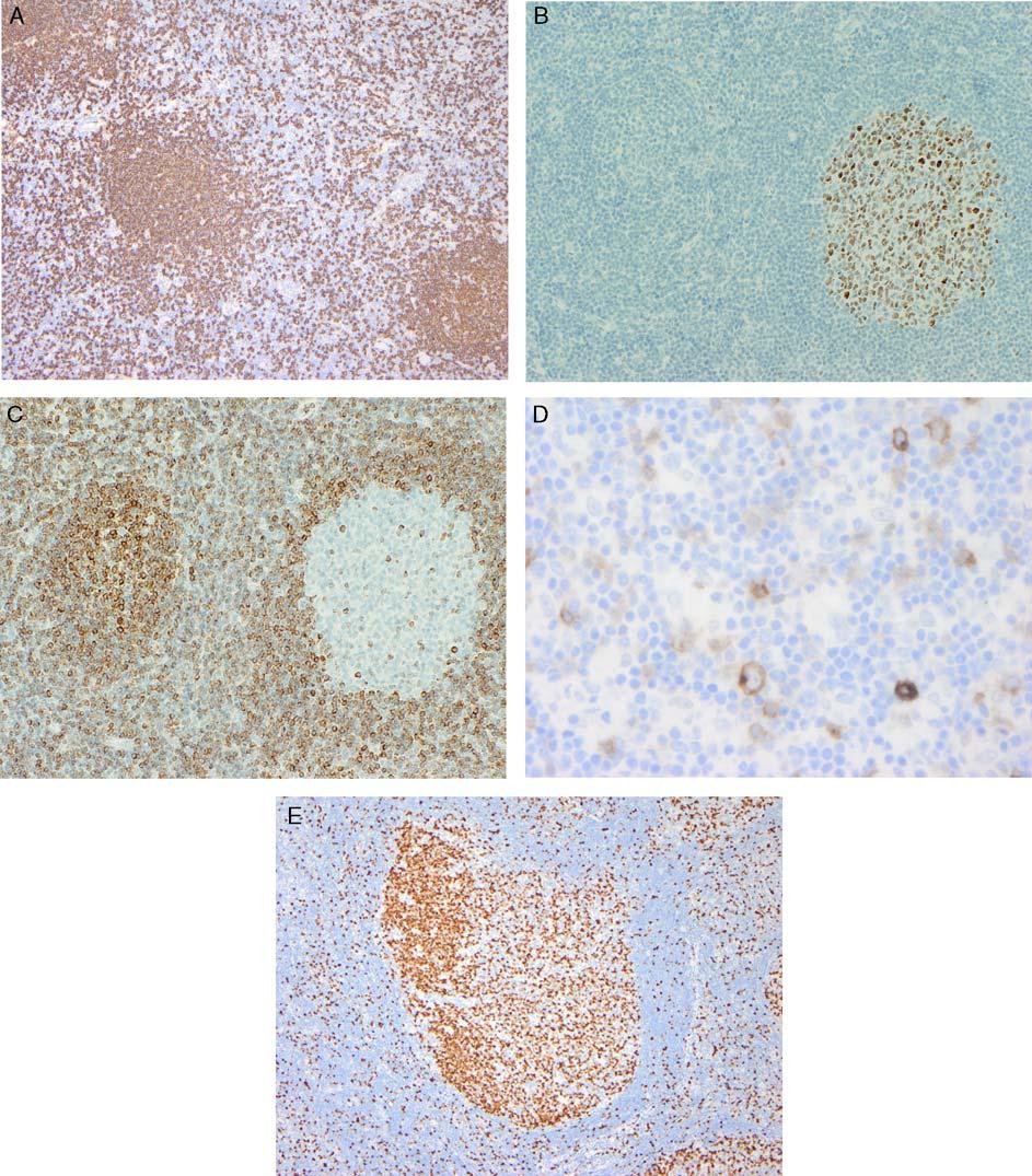 Lu and Chang Adv Anat Pathol Volume 18, Number 2, March 2011 FIGURE 1. Reactive lymph node. A, CD20 highlights B-cells primarily within follicles.