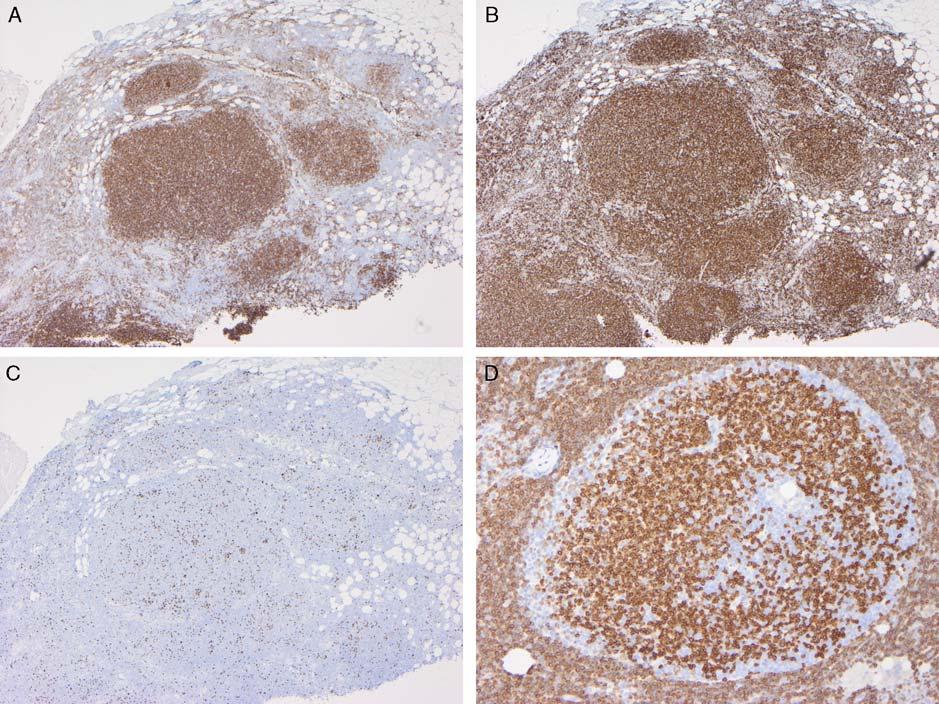 Lu and Chang Adv Anat Pathol Volume 18, Number 2, March 2011 FIGURE 2. Follicular lymphoma. A, CD10 is positive in neoplastic follicles.