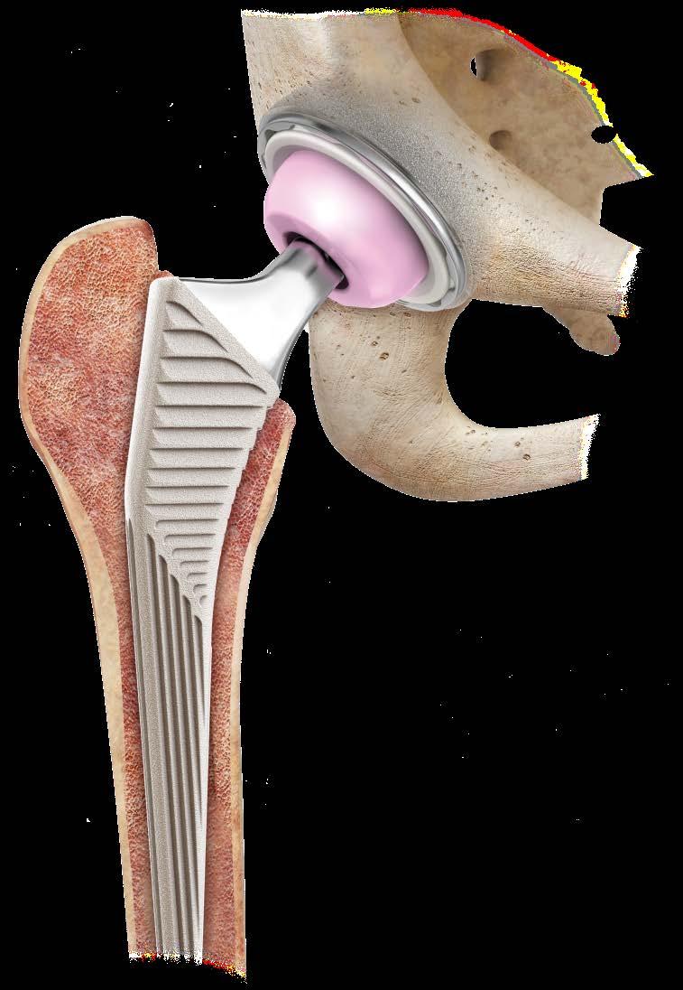 HIP REPLACEMENT A surgical procedure that removes and replaces diseased joint surfaces