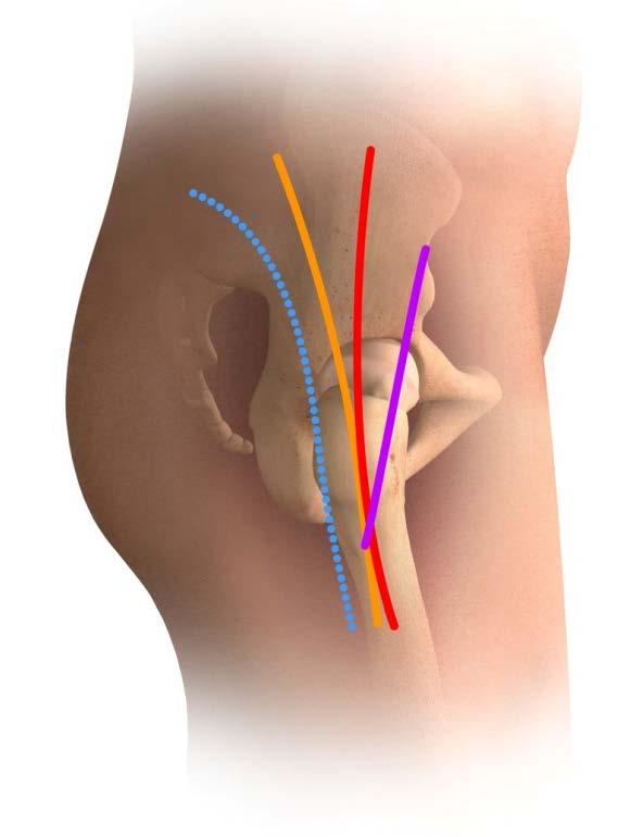 APPROACHES TO HIP REPLACEMENT SURGERY Anterior Approach incision on the front of your hip Anterolateral Approach incision on the side of your hip toward the front Direct Lateral Approach incision on