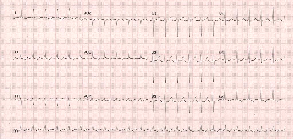 Flutter waves may be hidden in the QRS complexes and may be difficult to see Suspect if wavy baseline suggesting