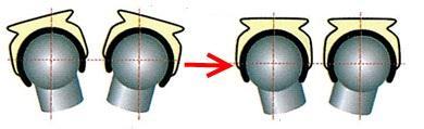 To compensate for divergent abutments, it is simple to parallel the Clix