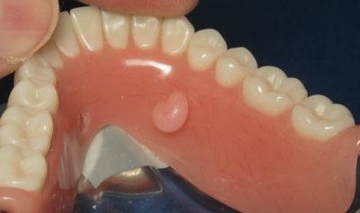 Place a low viscous mix of self curing acrylic resin into the relieved area of the denture, and seat the denture with