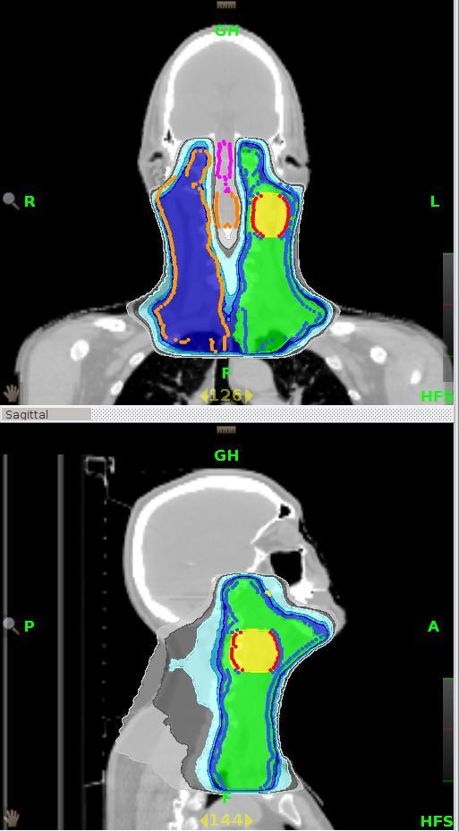 13 Gy/fraction Ipsilateral neck (PTV63): 63 Gy at 1.91 Gy/fraction Contralateral neck(ptv57.75): 57.