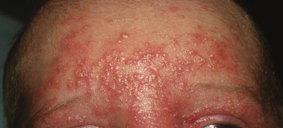 Figure 1.A Healthy 4-Week-Old Infant with Acne rare cases, neonatal acne may be caused by an inborn error of adrenal metabolism, and will be accompanied by other signs of hyperandrogenism.