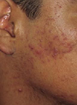 PROCEEDINGS Figure 2. Acne in a Healthy 14-Year-Old Boy with Darkly Pigmented Skin nificantly.