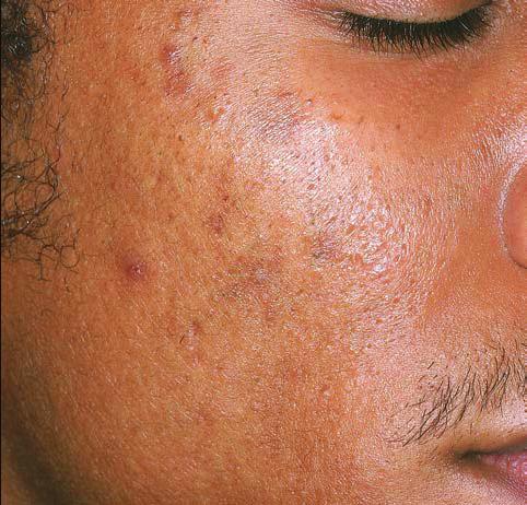Patients of color who have acne are at substantial risk of postinflammatory hyperpigmentation and keloidal scarring.