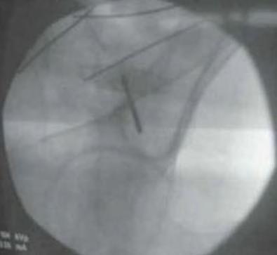 Iliac Screw Technique Fluoroscopic