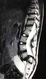 Indications Long spinal fusions Lumbar scoliosis in adults Paralytic scoliosis High-grade spondylolisthesis Flat