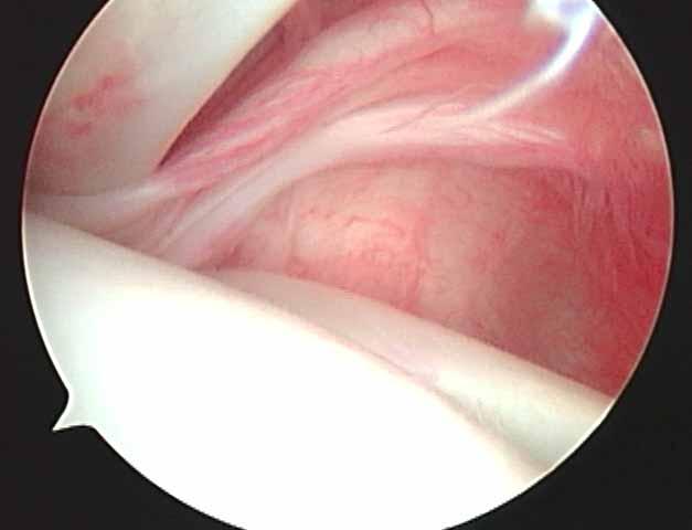 SGHL ~ 1/3-2/3 of thickness of long biceps - in 42 % only thin / rudimentary - origin: labrum /