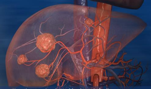 portal vein (A) Metastatic liver tumors: Majority of blood supply from