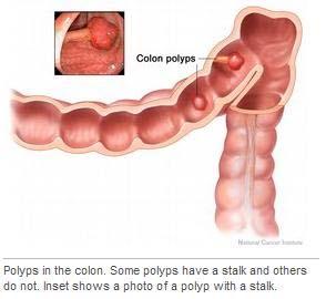 Age and health history can affect the risk of developing colon cancer.