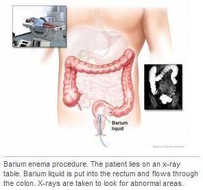 Barium enema: A series of x-rays of the lower gastrointestinal tract.
