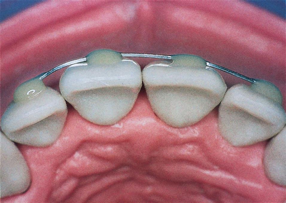 In addition, the splints should not irritate adjacent tissues (gingiva, lips).