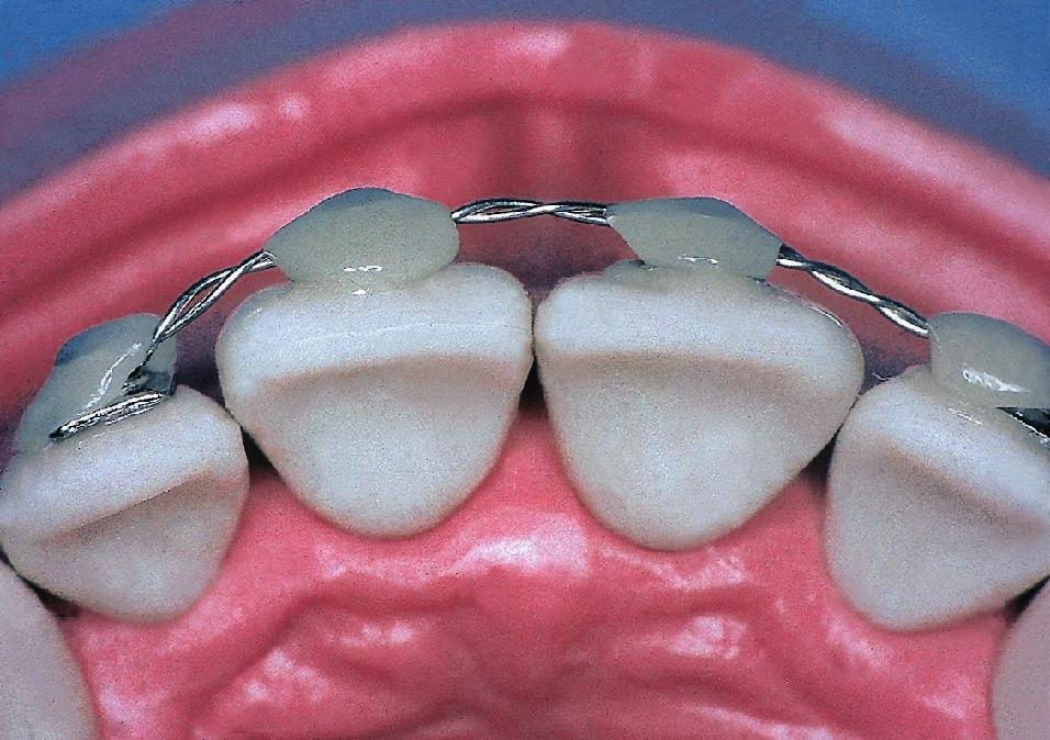 Comfort and discomfort of dental trauma splints Fig. 3. BS: bracket splint (occlusal view). Fig. 4. RS: resin splint (occlusal view). eating and oral hygiene.