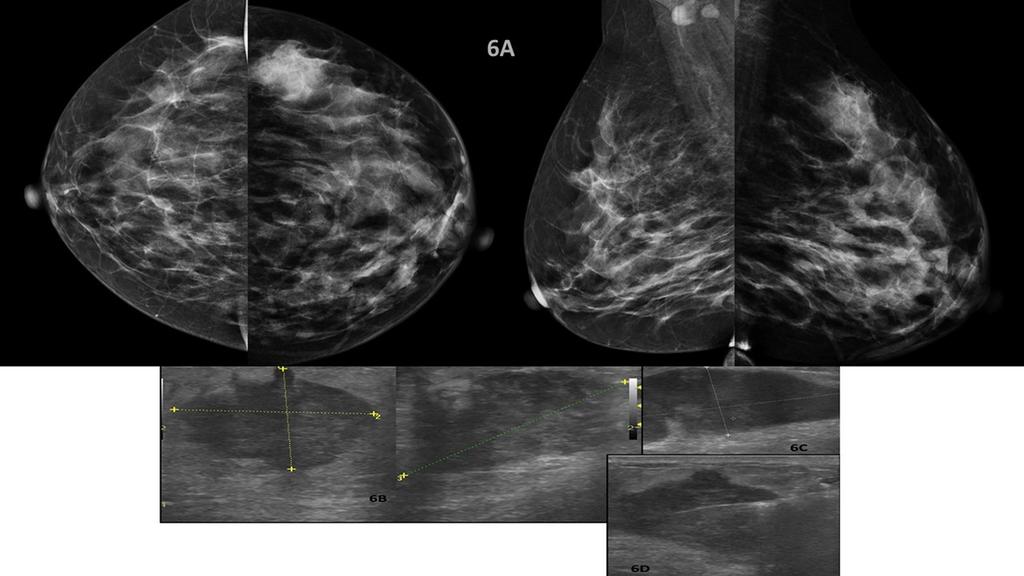 Fig. 6: (A, B, C & D) 40 years old lactating woman presented with palpable hard nonpainful lump of the upper outer quadrant of the left breast.