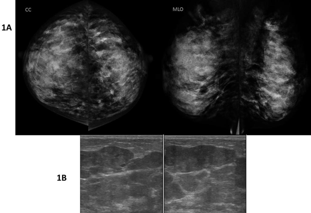 Fig. : (A & B) 28 years old lactating for 9 months presented with right breast lump felt.