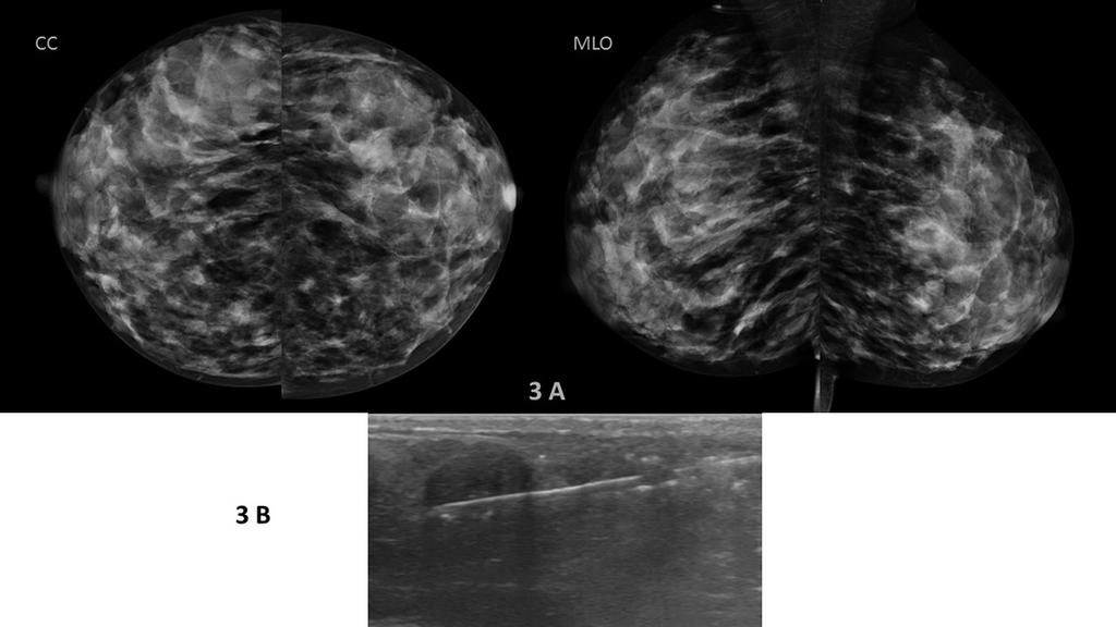 Fig. 3: (A & B) 2 years old lactating woman presented with left UOQ breast lump.