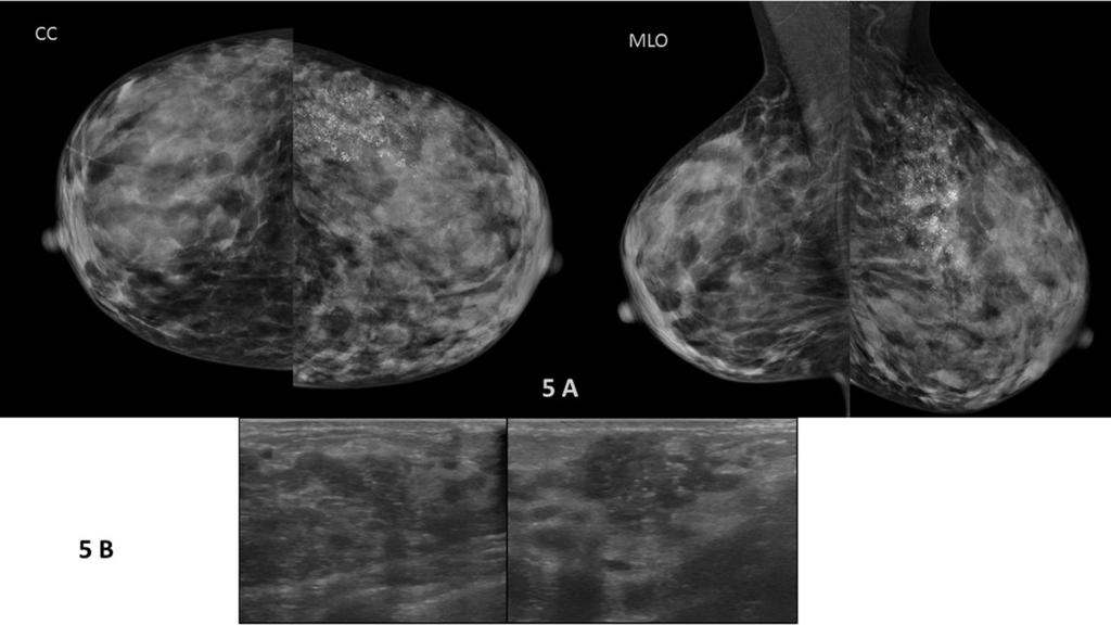 Pathology Number cases Active breast Papilloma tissue of 5 GranulomatousDuctal mastitis carcinoma Fibroadenoma 4 Images for this section: Fig.
