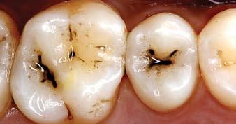 Traditional cutting burs, accessing deeper caries remove far more enamel at any cutting depth than Fissurotomy burs, which have been anatomically designed to enlarge
