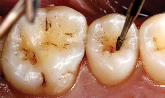 Almost half of these cavities have a narrow, fluoride hardened occlusal opening, masking the size and extent of defect to an explorer.