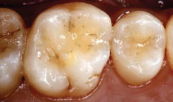 This is a phenomenon known as hidden caries, where the tooth appears caries free clinically and/or radiographically but is found to be carious by other diagnostic means.