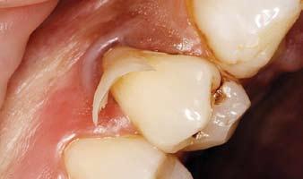 Flexure of teeth during function, with resultant stress concentration at the cementoenamal junction, has been