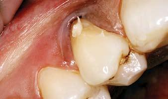 Adjustment of occlusal interferences prior to restorations of such areas is therefore prudent.
