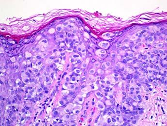 1) Histopathology (S09-8323A) (Fig.23.1.2, 23.1.3) - Proliferation of pagetoid cells at all layers of epidermis and some extend along the hair follicle -Pagetoid cells with large pleomorphic nuclei
