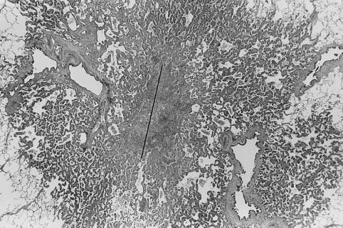 3 cm in size having central collapse/fibrosis (hematoxylin and eosin stain). The size of central collapse/fibrosis region was determined at its maximum dimension (black line) on low power view.