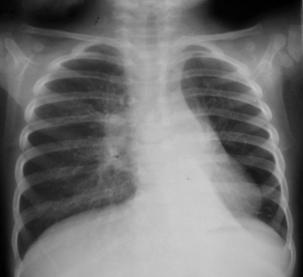 1 year old child TB primary Bilateral adenopathies, Left lower lobe