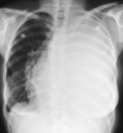 Opacity of the whole left lung field Do you think this is an atelectasis of the