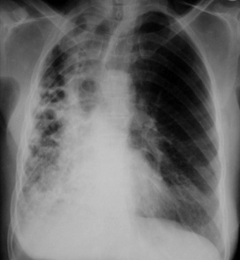 CXR from Lao TB Prevalence survey Right severe bronchiectasis, Retractile sequela of extensive TB of