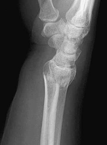 Open reduction and internal fixation was scheduled three days after the accident. The fracture was approached through a volar incision and was fixed after reduction with a 3.