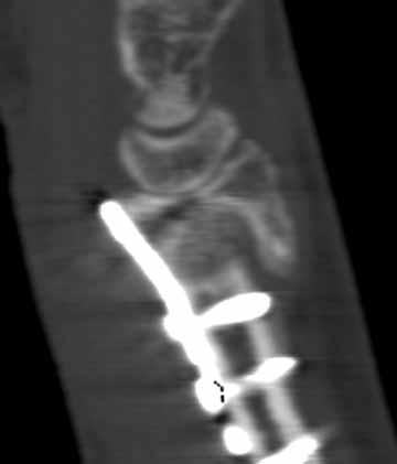 REKGE OF VOLR LOCKING PLTE 789 Fig. 5. CT-scan 3 months after the second operation, showing the demineralised bone matrix graft in the metaphyseal bone area.