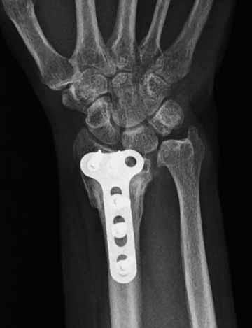 The reduced capillary vascularity associated with diabetes and the surgical periosteal devascularisation created a biological situation which was unfavourable for fracture healing.