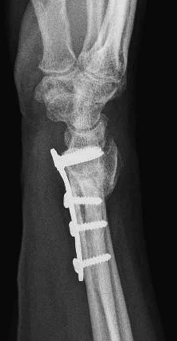In combination with the dorsal fracture comminution this gave an unstable construct that went on to failure.