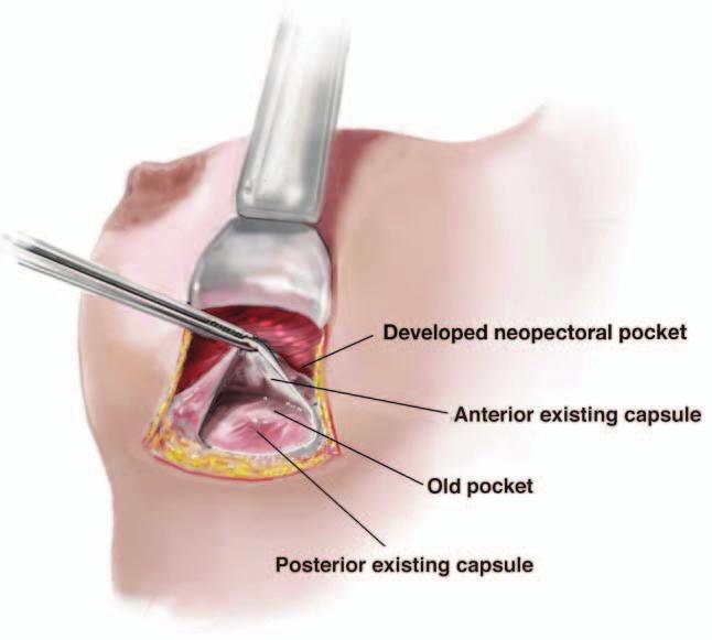 incision into the anterior capsule.