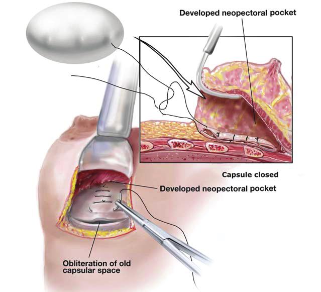anterior capsule with retractor elevation of the overlying pectoral muscle facilitates it.