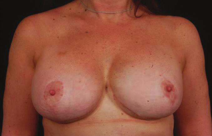 49-year-old woman with marked
