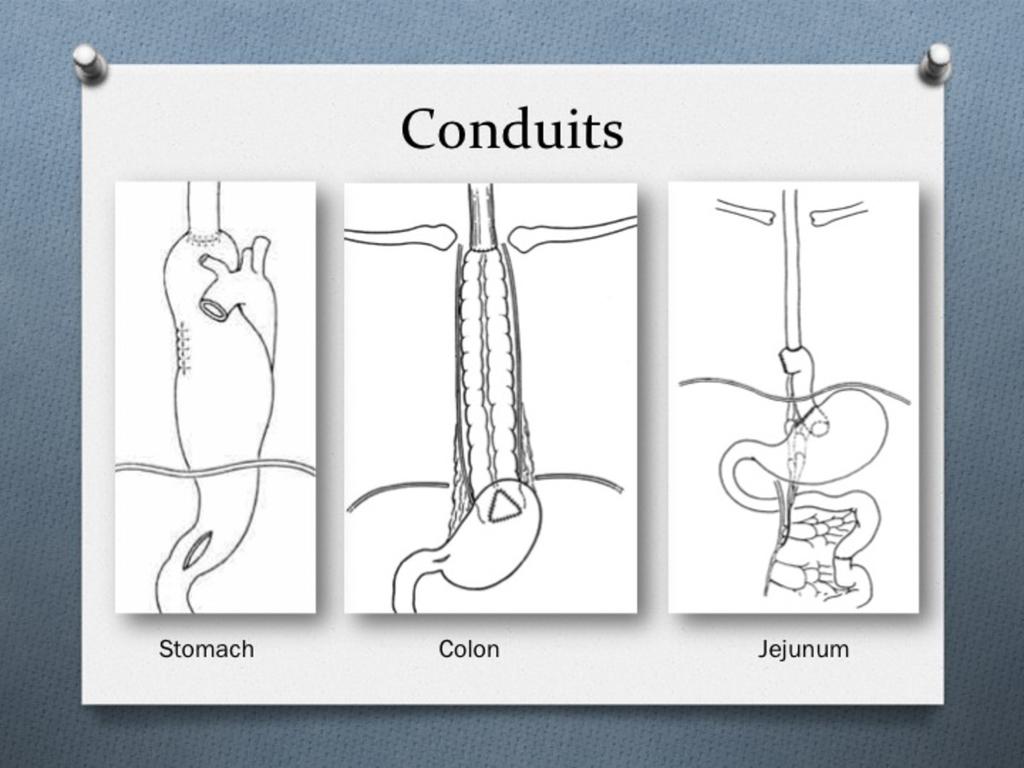 - Second most used - 3 anastomoses - more complicated - Can reach more proximal Jejunum - Merendino procedure Fig.
