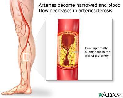 Arteriosclerosis Intermittent Claudication Cramping pain in