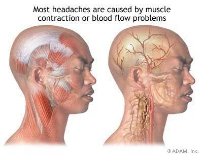 Vascular or Muscle Cephalgia Tension headache is the most