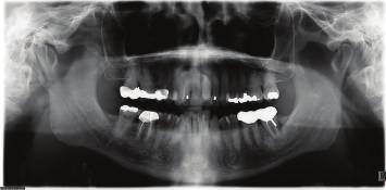 2 Case Reports in Dentistry Figure 1: Initial panoramic radiograph. Figure 2: Intraoral composite photographs following the extraction of the mandibular left central incisor.