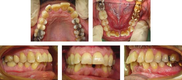 Therefore, this case report was aimed at illustrating the use of the Invisalign system in the treatment of an adult patient with severe mandibular anterior crowding after incisor extraction. 2.