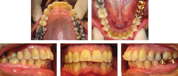 Case Reports in Dentistry 3 Figure 3: Progress intraoral composite photographs showing the bonded attachments. Figure 4: Posttreatment intraoral photographs. 2.2. Treatment Progress.