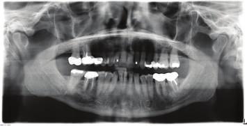 Before the delivery of the first aligner, vertical composite attachments were bonded to the mandibular teeth to prevent tipping during space closure and a button attachment was bonded on
