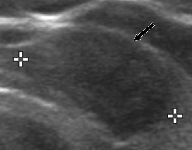 J.Y. Kim et al. / European Journal of Radiology 82 (2013) 321 326 323 Fig. 3. A malignant thyroid nodule with hypoechogenecity in a 58-year-old female patient. Transverse US shows a 16.