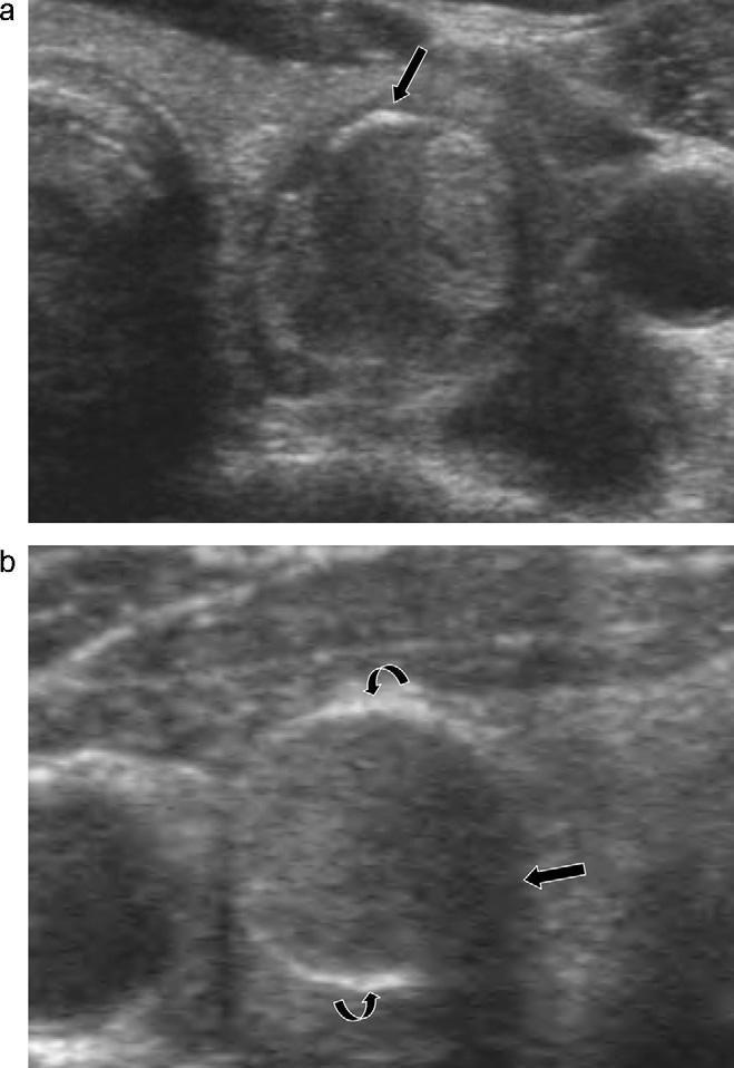 J.Y. Kim et al. / European Journal of Radiology 82 (2013) 321 326 325 Fig. 7. A malignant thyroid nodule with US characteristics suggestive of benign nodule in a 46-year-old female patient.
