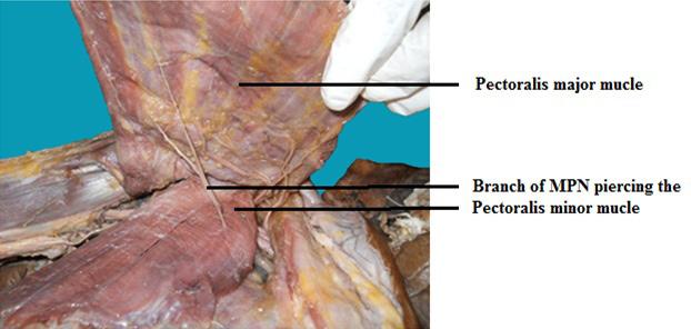 Then, the brachial plexus was dissected carefully after removing the clavicle to find out the origin of the pectoral nerves.